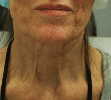 Acne Scar Reduction - Before