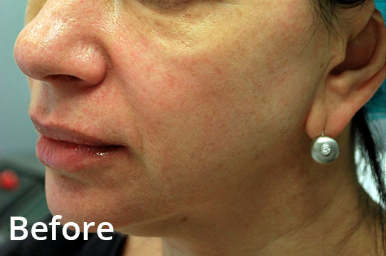 Nasolabial Folds & Skin Texture - Before