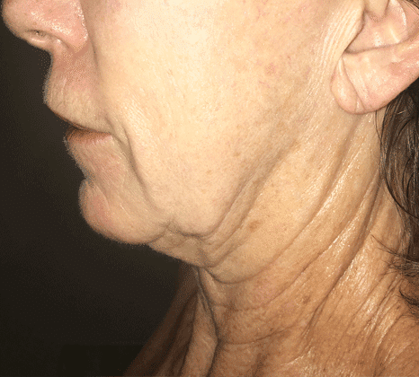 Jawline & Jowl Tightening - Before