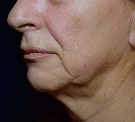 Neck Skin Tightening - Before