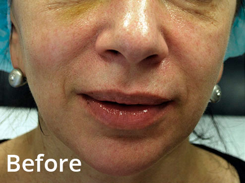 Smile Lines Softening - Before