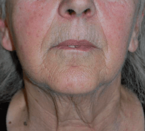 Overall Skin Texture - Before